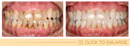 Tooth/Teeth Cleaning | Dental Cleaning in Andheri